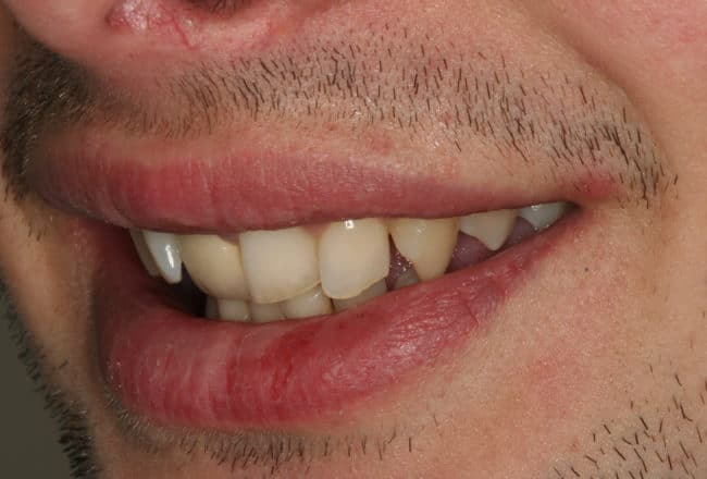 Minimal Prep Porcelain Veneers | Smile Makeover - Before