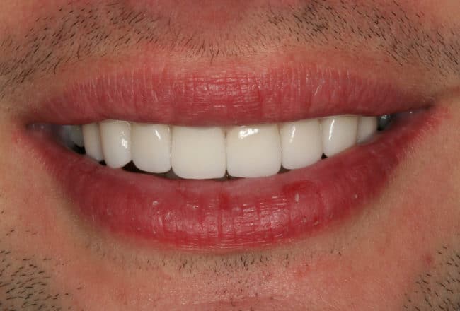 Minimal Prep Porcelain Veneers | Smile Makeover - After