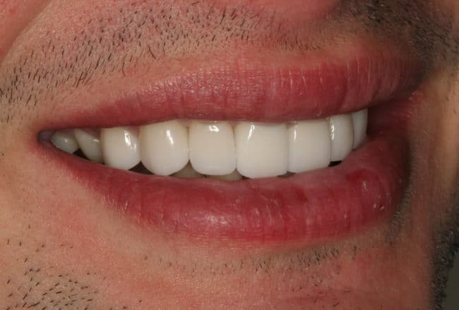 Minimal Prep Porcelain Veneers | Smile Makeover - After