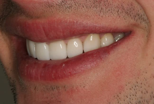 Minimal Prep Porcelain Veneers | Smile Makeover - After
