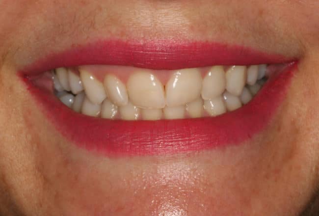 Teeth Straightening - Before
