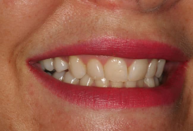 Teeth Straightening - Before