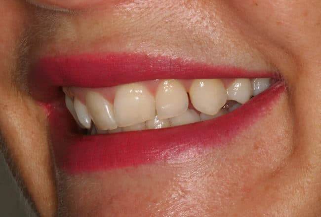 Teeth Straightening - Before