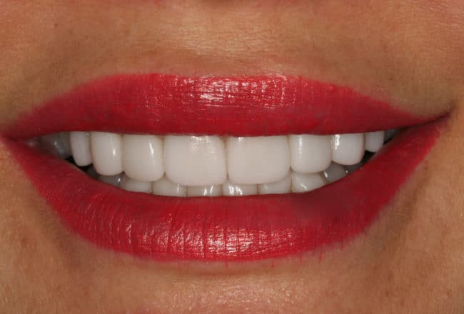 Teeth Straightening - After