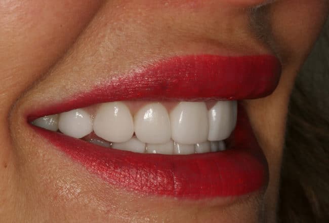 Teeth Straightening - After