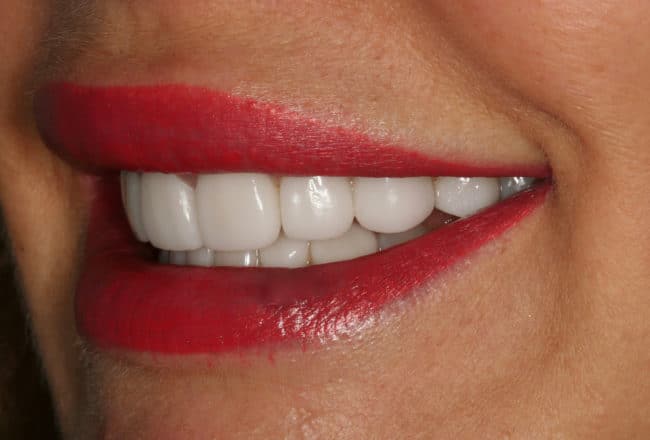 Teeth Straightening - After