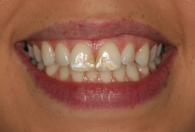 Before - Teeth Discolouration