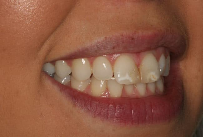 Before - Teeth Discolouration