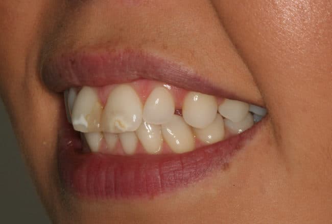 Before - Teeth Discolouration