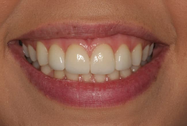 After - Teeth Discolouration