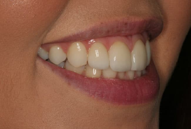 After - Teeth Discolouration