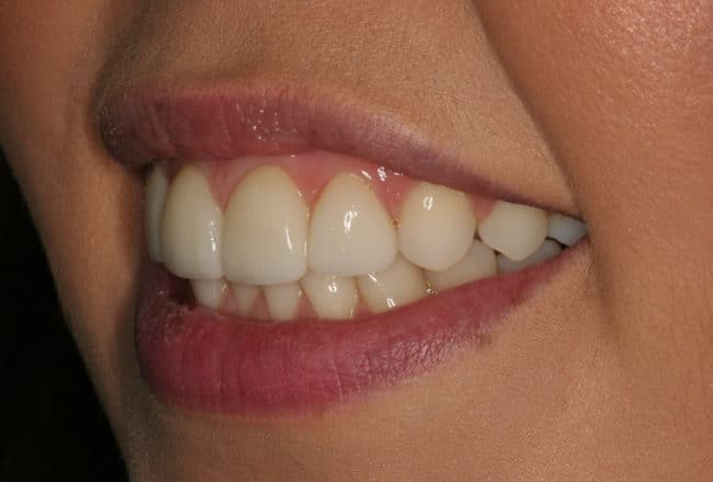 After - Teeth Discolouration
