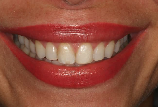 Before Porcelain Veneers Smile Makeover
