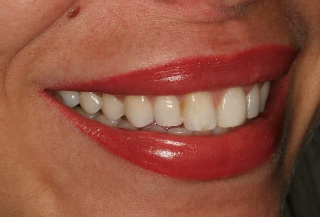 Before Porcelain Veneers Smile Makeover