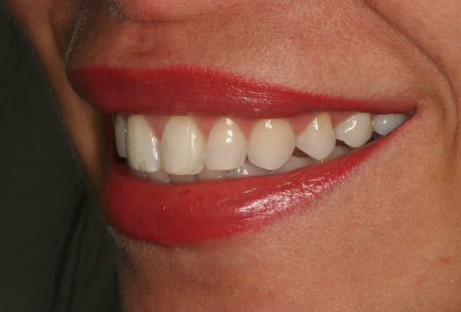 Before Porcelain Veneers Smile Makeover