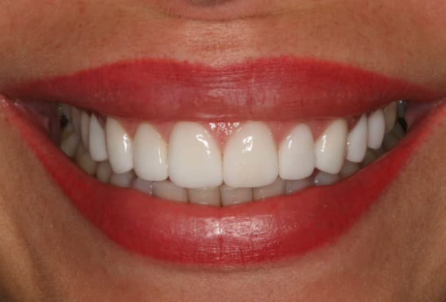 After Porcelain Veneers Smile Makeover
