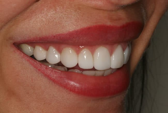 After Porcelain Veneers Smile Makeover