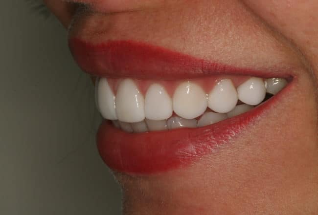 After Porcelain Veneers Smile Makeover
