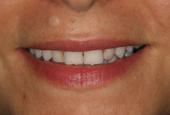 Smile Makeover | Minimal Prep Veneers