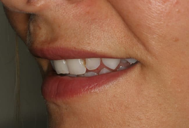 Smile Makeover | Minimal Prep Veneers