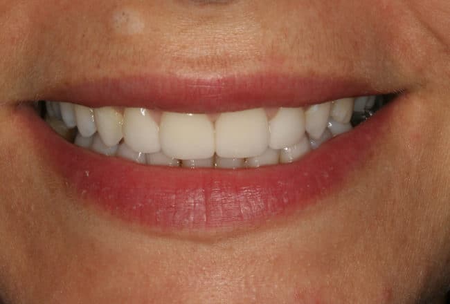 Smile Makeover | Minimal Prep Veneers
