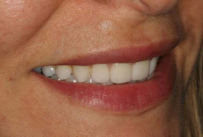 Smile Makeover | Minimal Prep Veneers