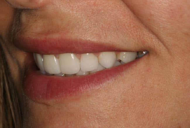 Smile Makeover | Minimal Prep Veneers