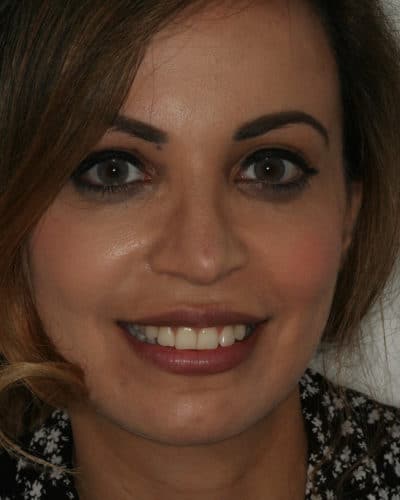 Whiter Straighter Teeth with Veneers