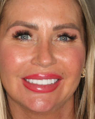 Perfect Smile Makeover - Porcelain Veneers & Crowns