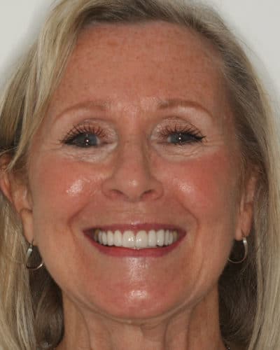 Veneers & Crowns for Youthful Smile