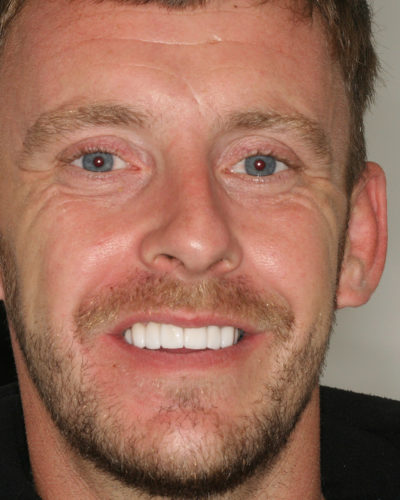 Porcelain Veneers for Worn Teeth