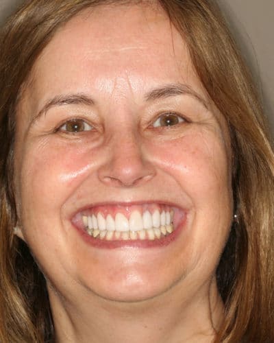 Veneers & Crowns Bright Smile