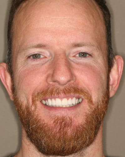 Porcelain Veneers Enhance your smile