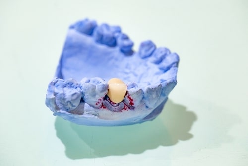 Replacement Veneers in London