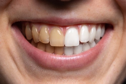 Philips Teeth Whitening London